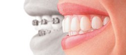 Статья. Выравнивание зубов без брекетов, что делать если кривые зубы взрослому           